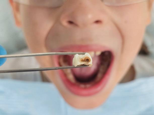 Best Knocked-Out Tooth (Avulsed Tooth) Treatment in Whitehouse, OH